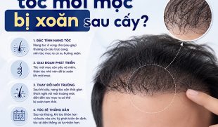 Vì sao tóc mới mọc bị xoăn sau cấy? Giải đáp từ chuyên gia