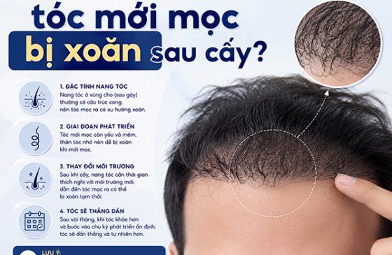 Vì sao tóc mới mọc bị xoăn sau cấy?