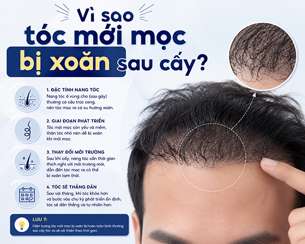 Vì sao tóc mới mọc bị xoăn sau cấy?