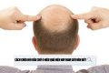 Cách chữa hói đầu chữ O hiệu quả hiện nay nam giới nên biết