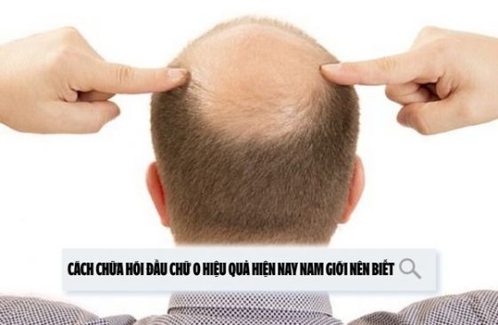 Cách chữa hói đầu chữ O hiệu quả hiện nay nam giới nên biết