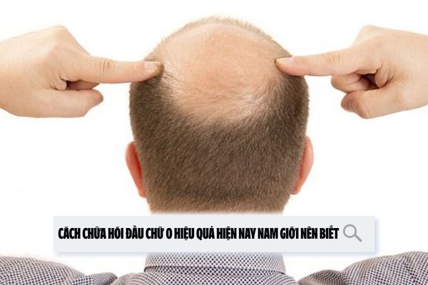 Cách chữa hói đầu chữ O hiệu quả hiện nay nam giới nên biết