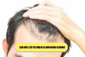 [Giải đáp]: Cấy tóc mùa hè có ảnh hưởng gì không? 