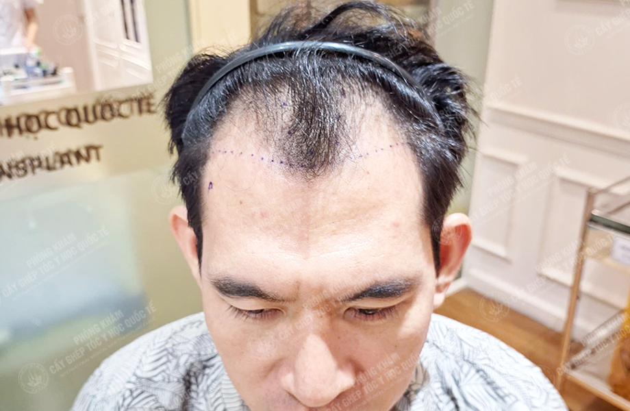 Đinh Văn Hùng - Cấy tóc đường chữ M 2