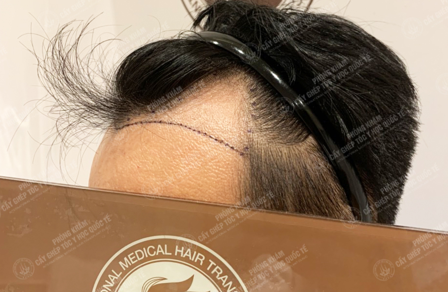 Nguyễn Văn Hoàn - Cấy tóc đường chữ M 2