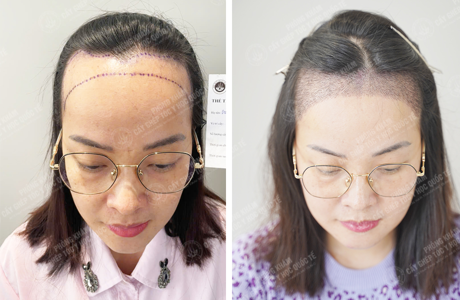  Đinh Thu Hà - Cấy tóc tự thân 1