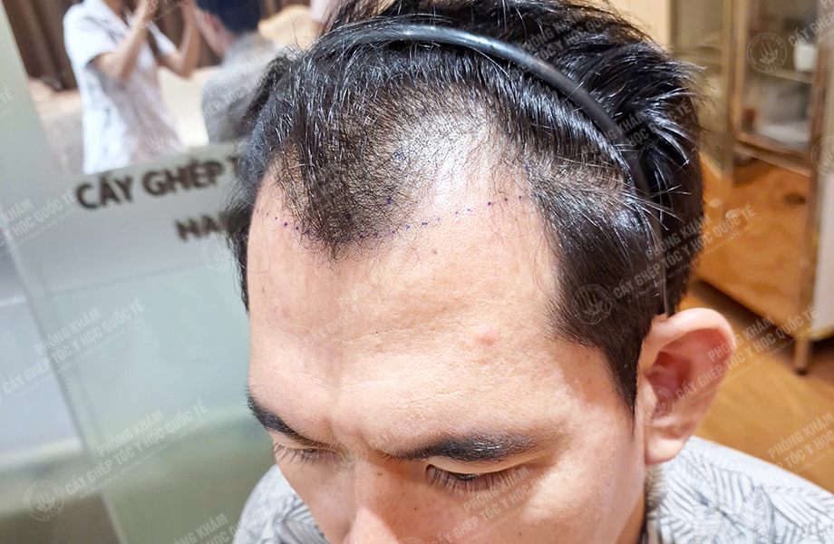 Đinh Văn Hùng - Cấy tóc đường chữ M 3