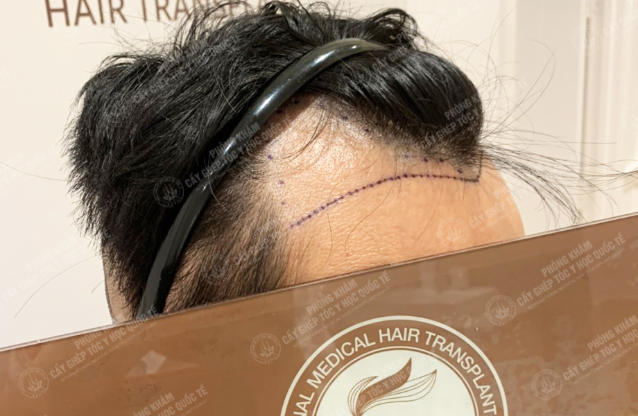 Nguyễn Văn Hoàn - Cấy tóc đường chữ M 3