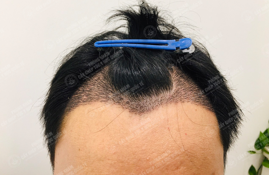 Nguyễn Văn Hoàn - Cấy tóc đường chữ M 4