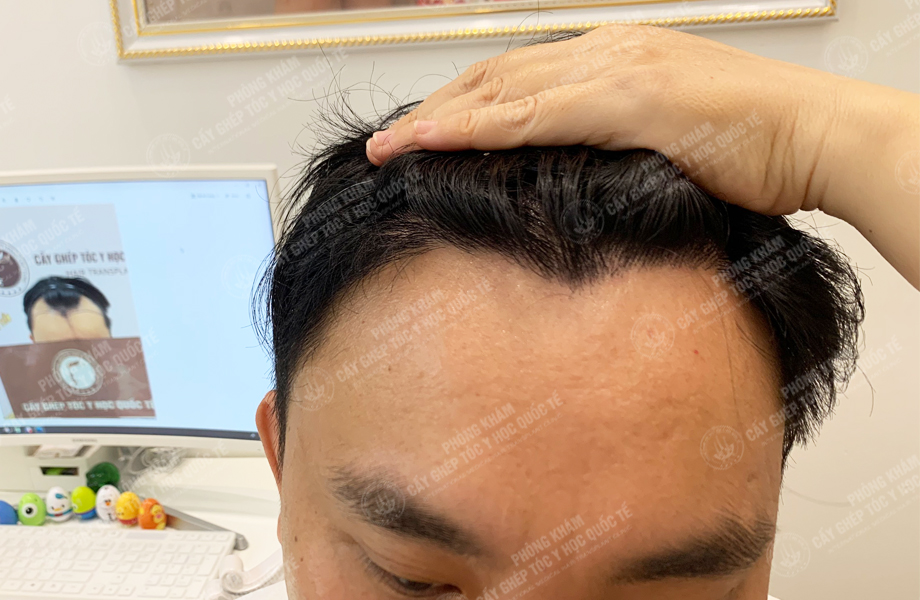 Nguyễn Văn Hoàn - Cấy tóc đường chữ M 6