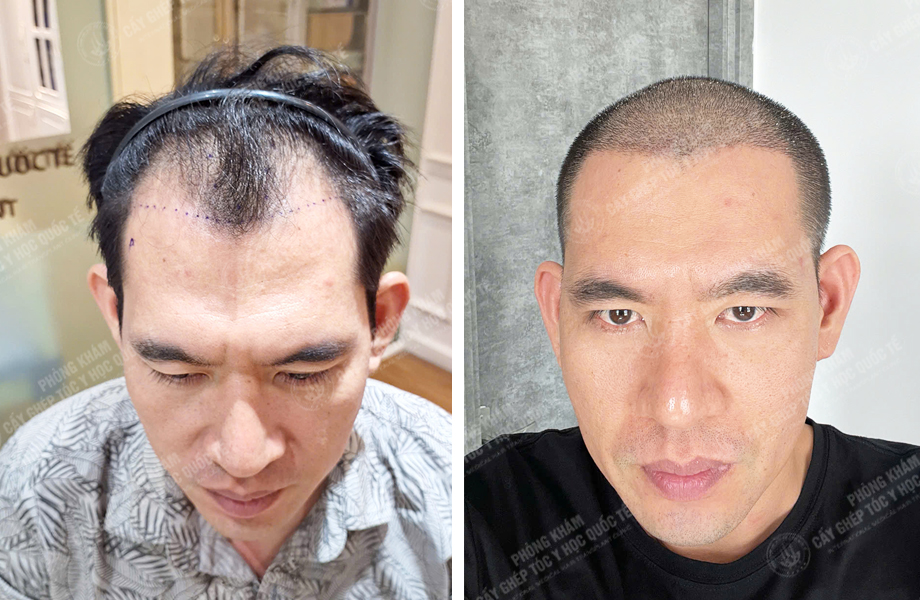  Đinh Văn Hùng - Cấy tóc đường chữ M 1