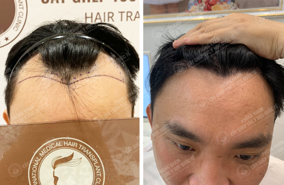  Nguyễn Văn Hoàn - Cấy tóc tự thân 1