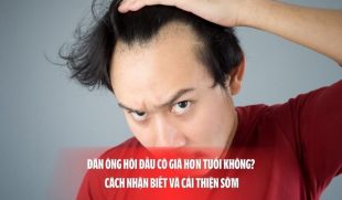 Đàn ông hói đầu có già hơn tuổi không? Cách nhận biết và cải thiện sớm