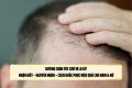 Đường chân tóc chữ M là gì? Nhận biết – nguyên nhân – cách khắc phục hiệu quả cho nam & nữ