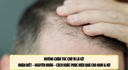 Đường chân tóc chữ M là gì? Nhận biết – nguyên nhân – cách khắc phục hiệu quả cho nam & nữ