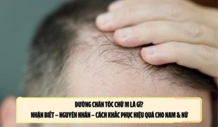 Đường chân tóc chữ M là gì? Nhận biết – nguyên nhân – cách khắc phục hiệu quả cho nam & nữ