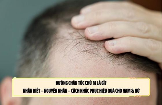Đường chân tóc chữ M là gì? Nhận biết – nguyên nhân – cách khắc phục hiệu quả cho nam & nữ