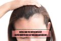 Đường chân tóc chữ M ở nữ là gì? Nguyên nhân và cách cải thiện hiệu quả hiện nay