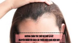 Đường chân tóc chữ M ở nữ là gì? Nguyên nhân và cách cải thiện hiệu quả hiện nay
