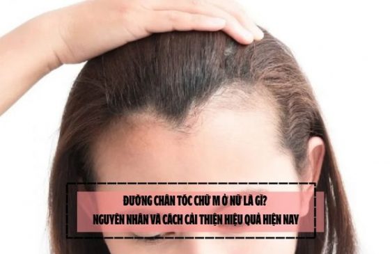 Đường chân tóc chữ M ở nữ là gì? Nguyên nhân và cách cải thiện hiệu quả hiện nay