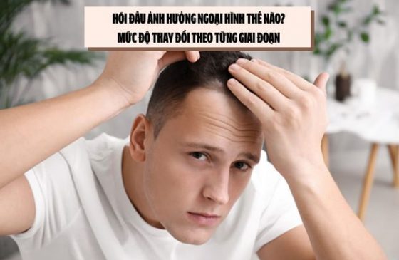 Hói đầu ảnh hưởng ngoại hình thế nào? Mức độ thay đổi theo từng giai đoạn 
