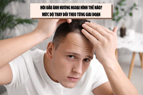 Hói đầu ảnh hưởng ngoại hình thế nào? Mức độ thay đổi theo từng giai đoạn 