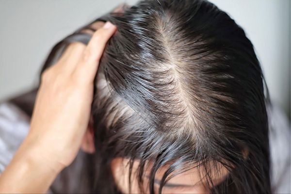 Cách chữa hói đỉnh đầu nữ: Giải pháp phục hồi tóc hiệu quả theo từng mức độ