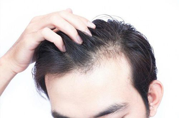 Những trường hợp thường được bác sĩ khuyên đi cấy tóc đối với nam giới