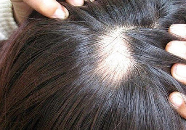 Những trường hợp thường được bác sĩ khuyên đi cấy tóc