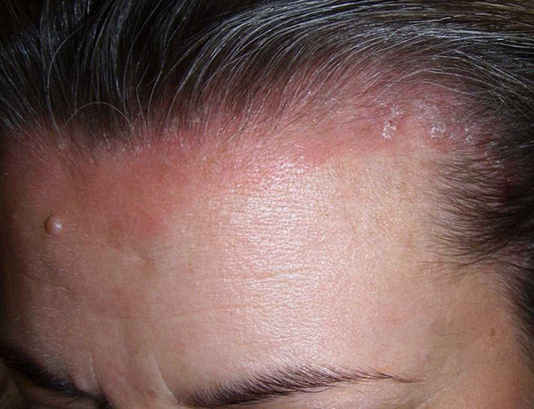 Một số trường hợp chưa nên đi cấy tóc ngay