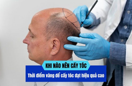 Khi nào nên cấy tóc? Thời điểm vàng để cấy tóc đạt hiệu quả cao