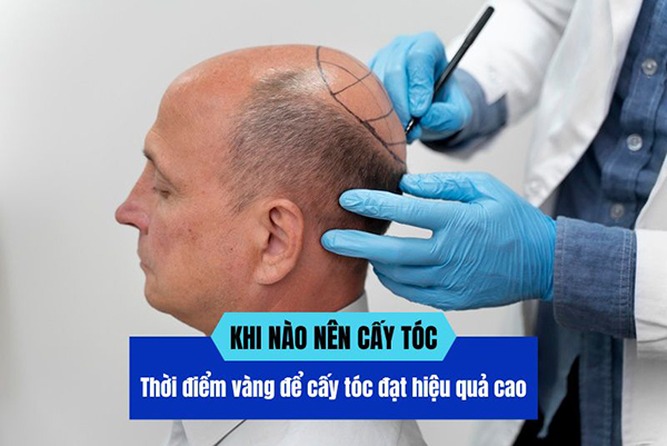 Khi nào nên cấy tóc? Thời điểm vàng để cấy tóc đạt hiệu quả cao