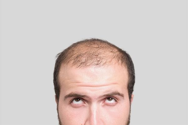 Hói đầu ảnh hưởng ngoại hình thế nào? Mức độ thay đổi theo từng giai đoạn 