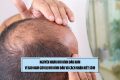 Nguyên nhân hói đỉnh đầu nam: Vì sao nam giới bị hói đỉnh đầu và cách nhận biết sớm