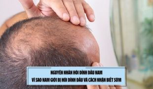 Nguyên nhân hói đỉnh đầu nam: Vì sao nam giới bị hói đỉnh đầu và cách nhận biết sớm