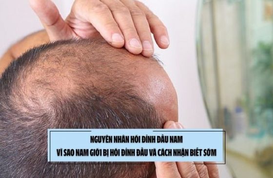 Nguyên nhân hói đỉnh đầu nam: Vì sao nam giới bị hói đỉnh đầu và cách nhận biết sớm