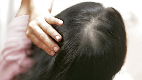 Tóc thưa hói ở đỉnh đầu có phục hồi được không?