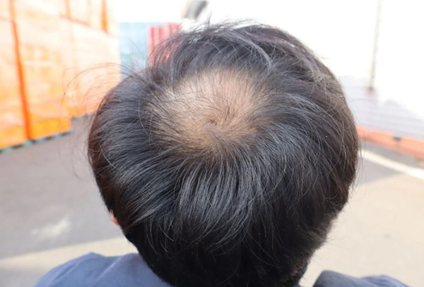 Tóc thưa hói ở đỉnh đầu có phục hồi được không?