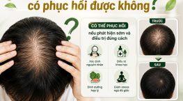 [Giải Đáp] : Tóc thưa ở đỉnh đầu có phục hồi được không?
