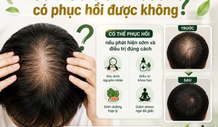 [Giải Đáp] : Tóc thưa ở đỉnh đầu có phục hồi được không?