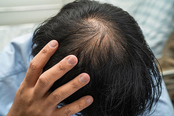 Tóc thưa hói ở đỉnh đầu có phục hồi được không?