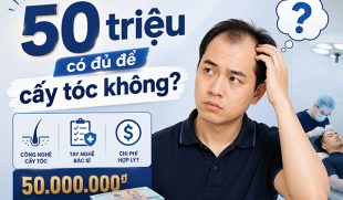50 triệu có đủ để cấy tóc không? Tìm hiểu chi phí thực tế