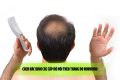 Cách xác định các cấp độ hói theo thang đo Norwood