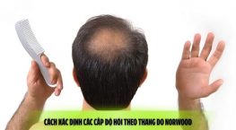 Cách xác định các cấp độ hói theo thang đo Norwood