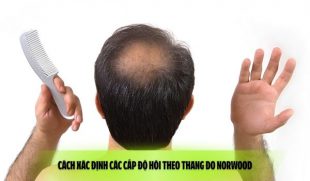 Cách xác định các cấp độ hói theo thang đo Norwood