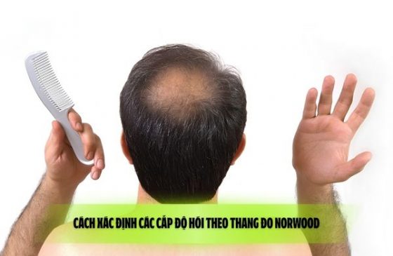 Cách xác định các cấp độ hói theo thang đo Norwood