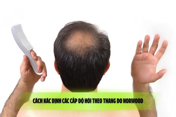 Cách xác định các cấp độ hói theo thang đo Norwood