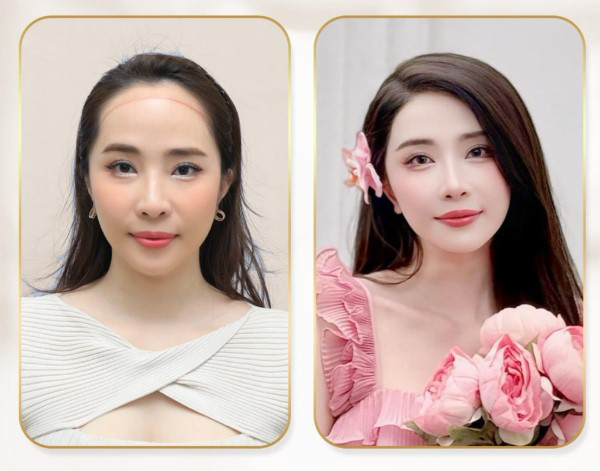 Cấy tóc điều chỉnh đường chân tóc