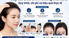 Cấy tóc điều chỉnh đường chân tóc: Quy trình, chi phí và hiệu quả thực tế