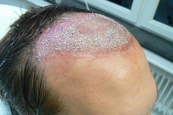Cấy tóc giá rẻ có nguy hiểm không? Cảnh báo 6 rủi ro nghiêm trọng